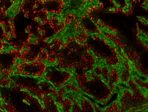 Murine SCC tumor stained for p63 (red) and Smooth Muscle Actin (Green)